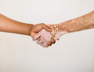 Vitiligo, un trastorno de la piel que requiere tratamientos específicos y cuidados