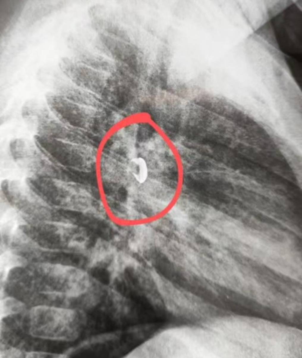 Radiografía de tórax del niño. Foto: Captura de pantalla