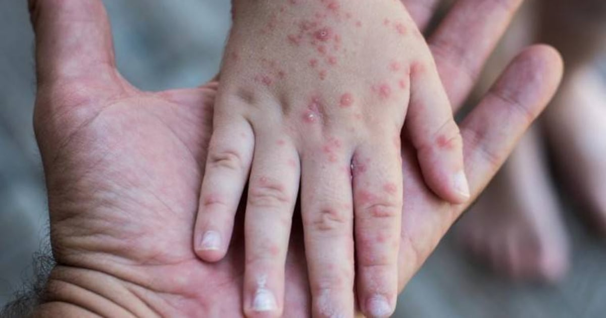Alerta por Sarampión en San Pedro: Confirman Caso en Niño No Vacunado y Autoridades Activan Protocolos