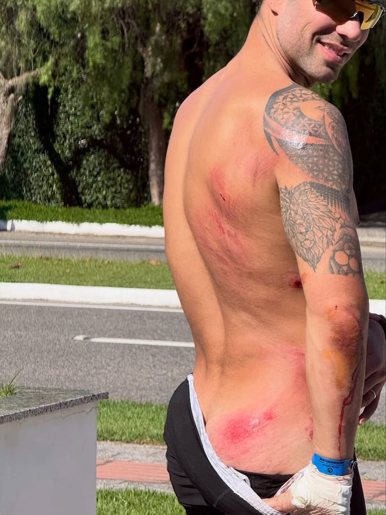 Renato Prono mostró cómo quedaron algunas partes de su cuerpo tras el accidente.