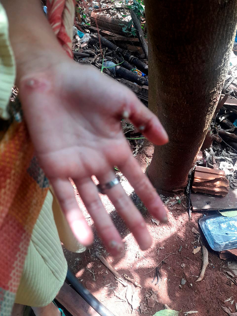 La niña que fue rescatada de la casa donde vivía con su abuela y abuelastro, porque estaba infestada de pique en manos y pies, ahora se conoció que también sufrió abuso sexual. Foto: Gentileza