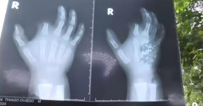 Este le mordió en la mano derecha y lamentablemente le tuvieron que amputar uno de sus dedos. Foto: Captura de pantalla