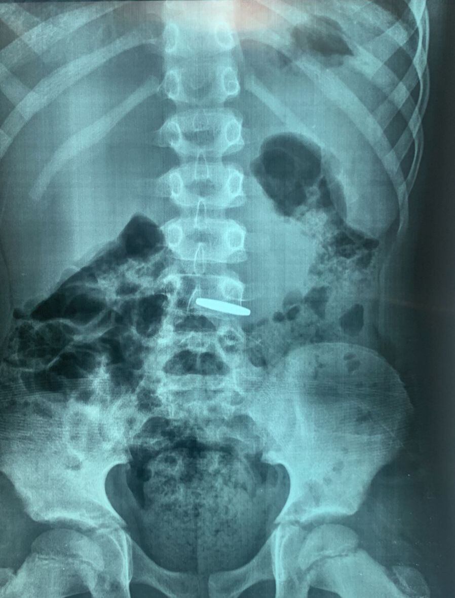 Cerca de cien intervenciones en niños para extracción de objetos extraños se realizaron en el Hospital Tesai de Ciudad del Este, en el 2024. Foto: Gentileza