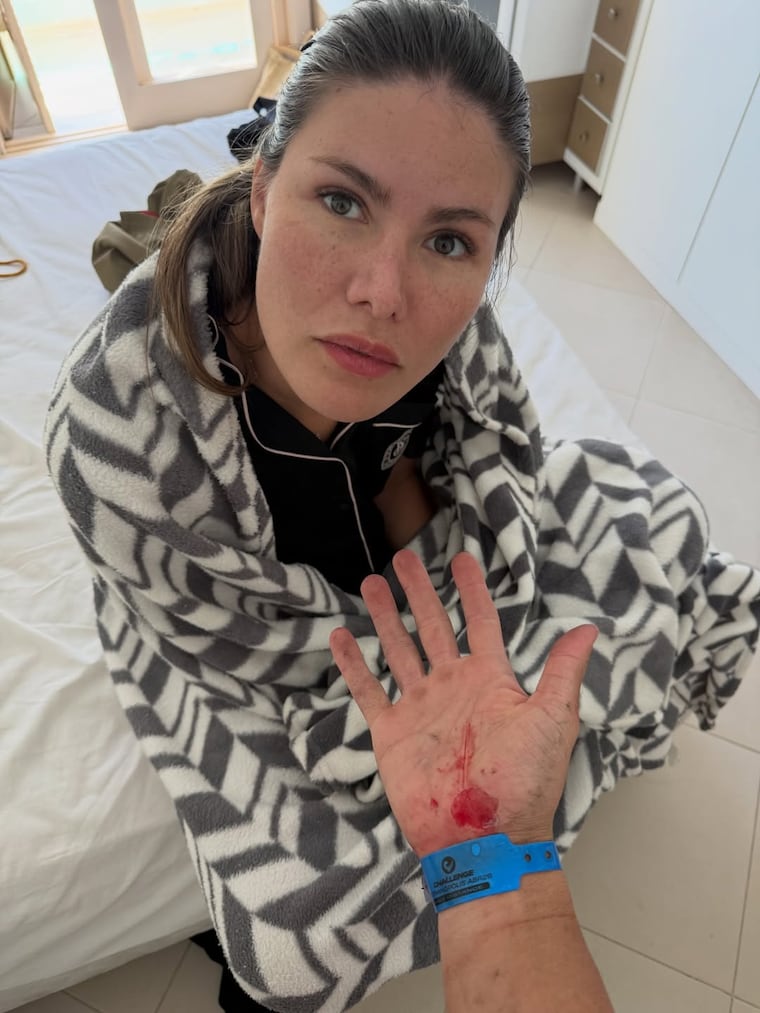 Alba Riquelme junto a la mano lastimada de Renato Prono.