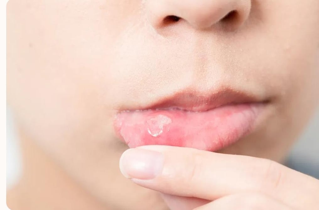 El herpes labial, también conocido como ampolla febril o herpes oral, se manifiesta inicialmente con pequeñas ampollas alrededor de los labios y la boca. En algunos casos, también puede afectar el mentón, las mejillas y la nariz.