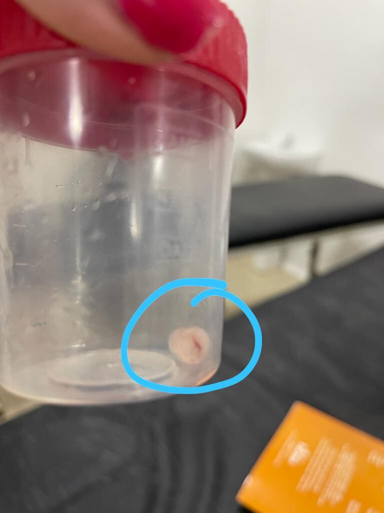 Desde hace unos 20 días la niña presentaba una tos persistente, su madre la llevó en reiteradas ocasiones para consultar, pero no había diagnóstico. Foto: Gentileza