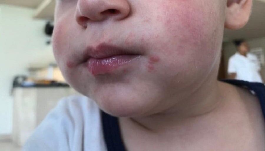 El Departamento de Emergencias Pediátricas de Clínicas recibe 30 % de consultas diarias por la patología, indicaron. Foto: Gentileza