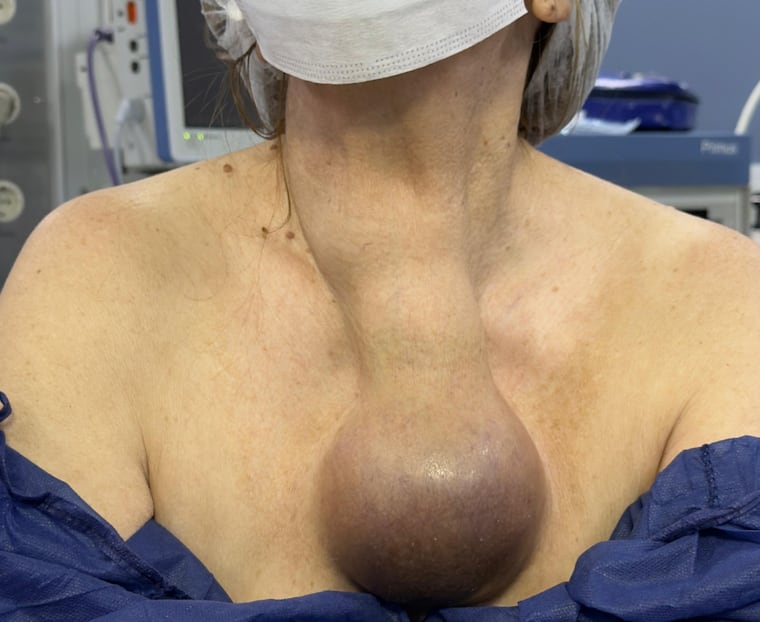 El tumor extraído a la paciente.