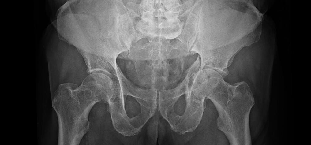 La consecuencia directa de la osteoporosis “es el aumento del riesgo de fracturas y el incremento de la incidencia de las fracturas por fragilidad”, indica una profesional. Foto: Gentileza