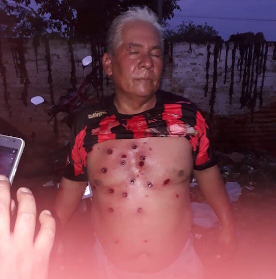 Un aficionado muestra la descarga de balines de goma que recibió de pleno.