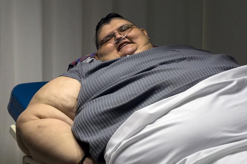 El especialista agregó que existe una buena expectativa de que Pedro, de 32 años, logre reducir la mitad de su sobrepeso a los seis meses de la primera cirugía. AFP. 