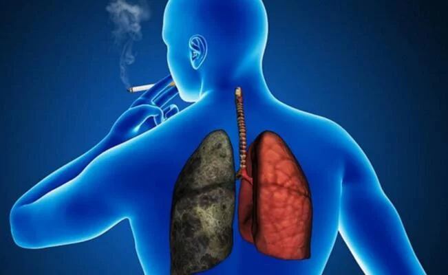 El Doctor Edward Bernal, de la Cátedra de Neumología del Hospital de Clínicas, explicó que los síntomas de un cáncer pulmonar no se manifiestan en un primer estadío. FOTO: WEB.