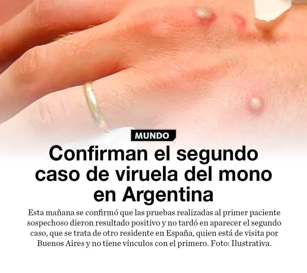 Confirman el segundo caso de viruela del mono en Argentina