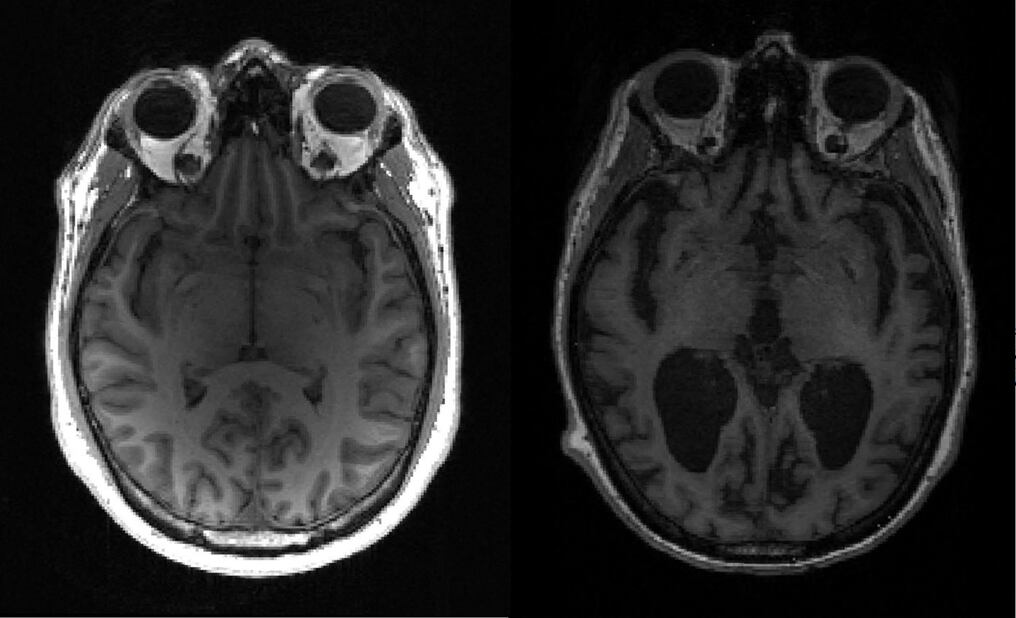 Los investigadores utilizaron cerca de 400 muestras cerebrales post mortem de enfermos de Alzheimer, así como 100 PET de personas que viven con la enfermedad para rastrear la acumulación de tau, una de las dos proteínas clave implicadas en la afección. Foto: AFP.