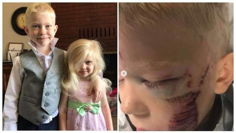 Debido al ataque canino, Bridger Walker casi pierde un ojo, pero afortunadamente se pudo salvar. 