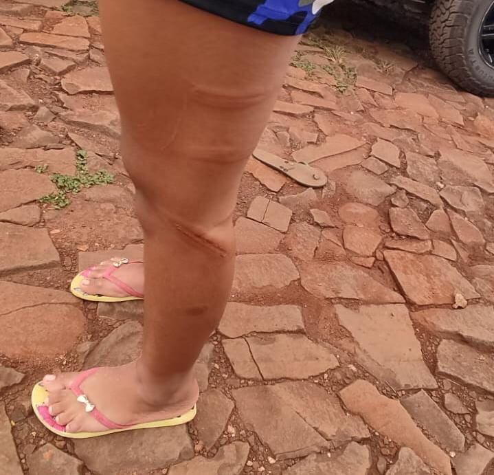 Un hombre golpeó a su hija de 13 años con manguera y le produjo lesiones en todo el cuerpo. La fiscal Viviana Sánchez procesó al supuesto agresor que habría reaccionado así en medio de una discusión que se dio porque la escolar habría faltado a clases. Foto: Gentileza.