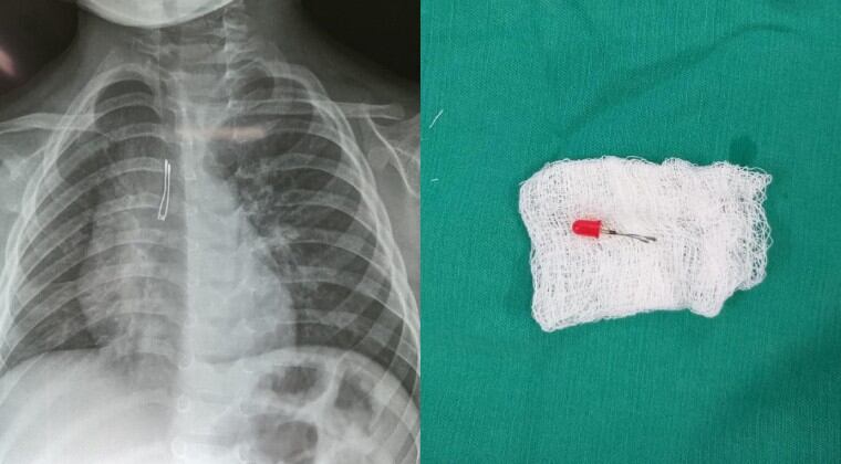 El pequeño había ingresado al Hospital Nacional de Itauguá por un cuadro de tos intensa, lo que provocó la preocupación de su madre, quien comentó a los médicos que su hijo tuvo dicho síntoma luego de haber metido algo en la boca. Foto: Facebook.