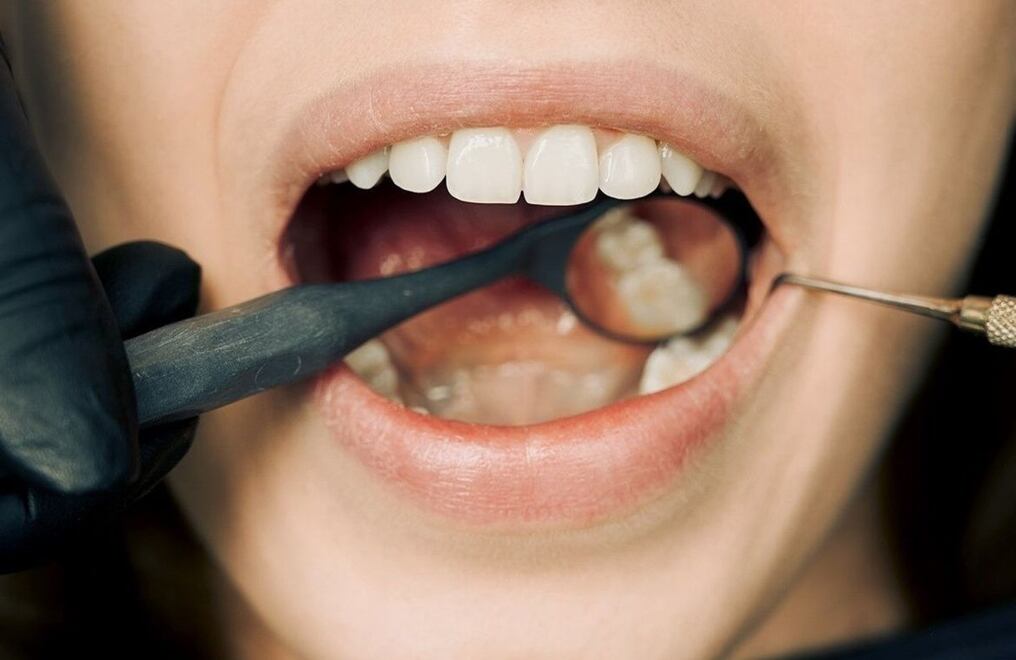 La placa dental se elimina con una correcta técnica de cepillado. Foto: Ilustrativa.