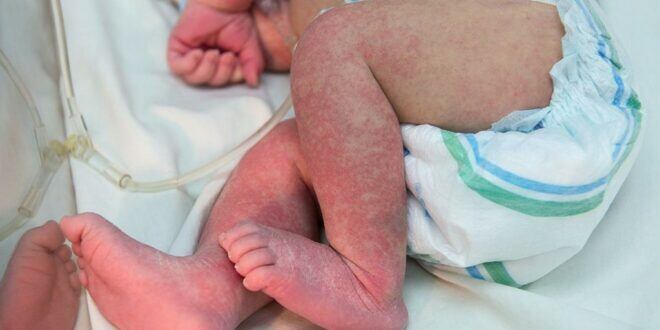 La edad más riesgosa en la infección por virus de chikunguya es la que comprende desde el nacimiento a los dos meses, pero afirman que no todos los casos en bebés son fatales. Foto: Archivo